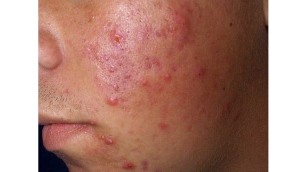 Actviz Paris REVITADERM IMPERFECTION THERAPY Regenerates the skin PORE TIGHTENING - Image 3